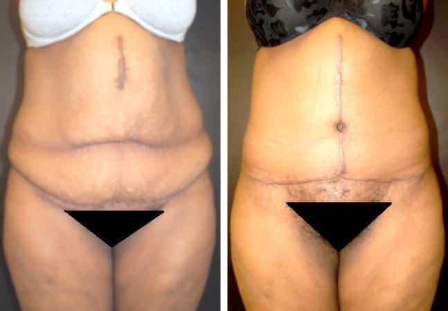 Abdominoplasty  Best Tummy Tuck Results New York